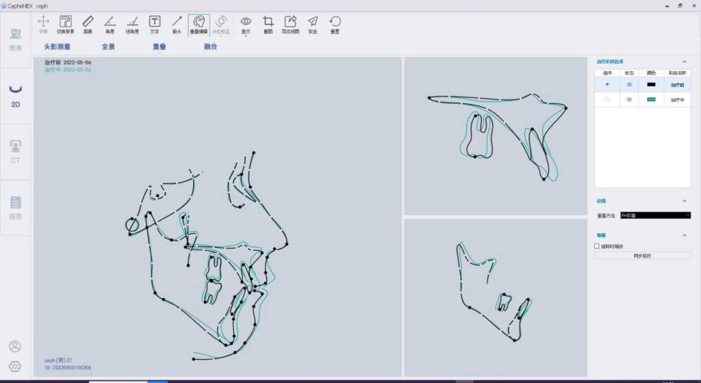 CephNEX正畸软件丨专业便捷