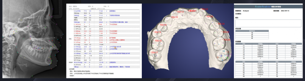 新品预告 | FusionOne正畸影像智能处理系统 即将上线