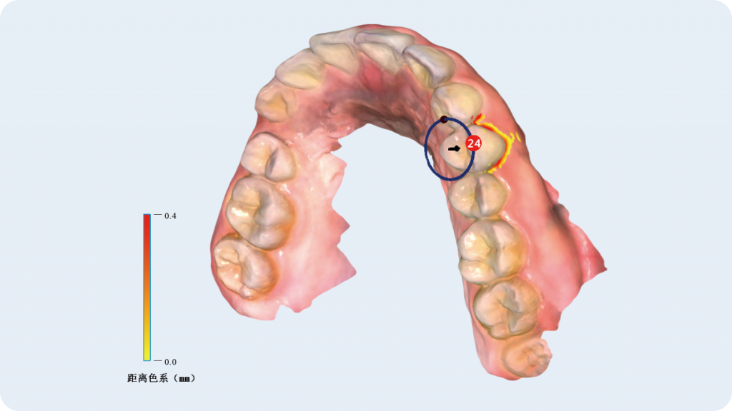 FusionScanner SU系列口腔数字印模仪 | 朗视正畸